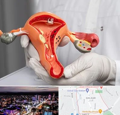 دکتر سرطان رحم در گلسار رشت 