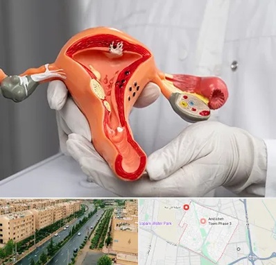 دکتر سرطان رحم در فاز سه اندیشه