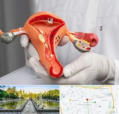 دکتر سرطان رحم در سرسبز 