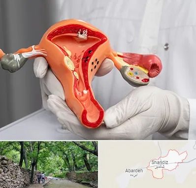 دکتر سرطان رحم در شاندیز مشهد