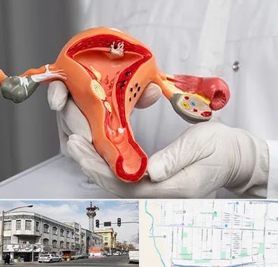 دکتر سرطان رحم در 17شهریور