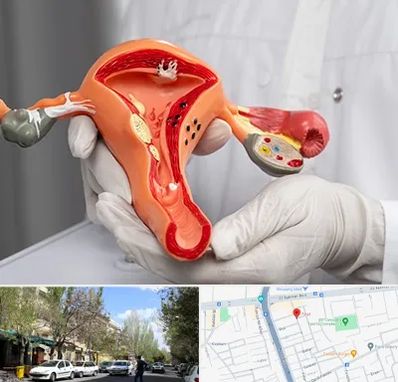 دکتر سرطان رحم در کوی فیروز تبریز