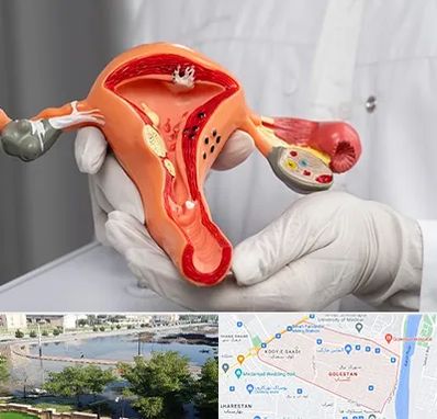 دکتر سرطان رحم در گلستان اهواز 