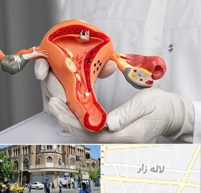 دکتر سرطان رحم در لاله زار