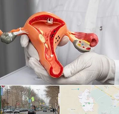 دکتر سرطان رحم در نظرآباد کرج 