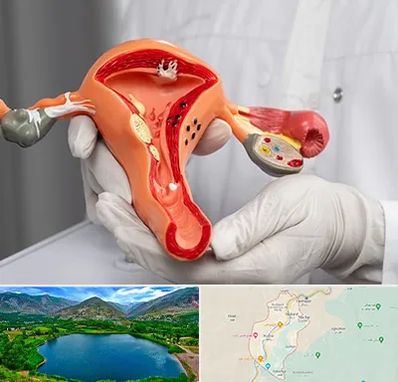 دکتر سرطان رحم در رودبار