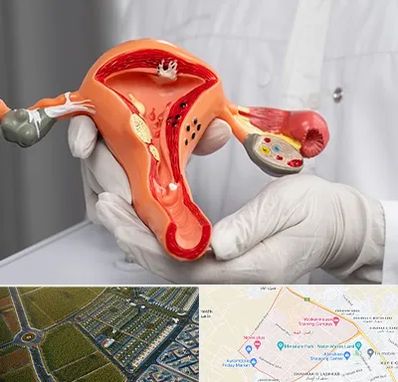 دکتر سرطان رحم در الهیه مشهد 