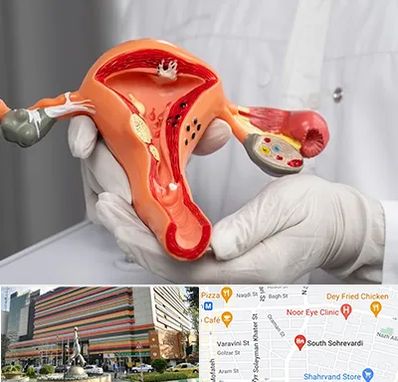 دکتر سرطان رحم در سهروردی 