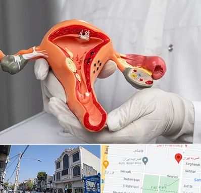 دکتر سرطان رحم در افسریه