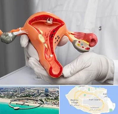 دکتر سرطان رحم در کیش