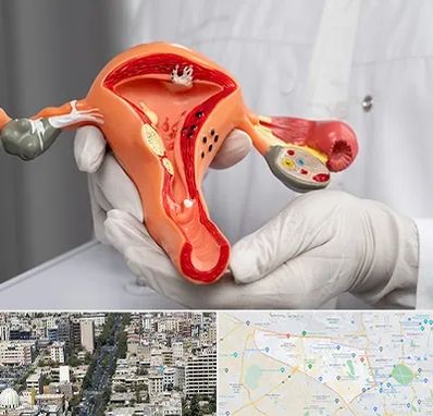 دکتر سرطان رحم در منطقه 18 تهران 