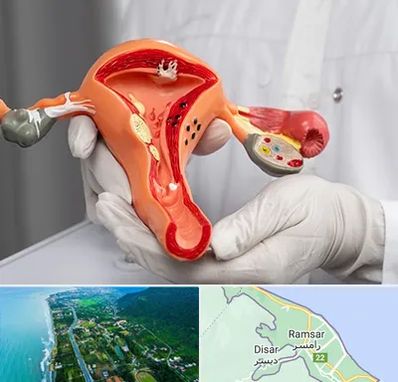 دکتر سرطان رحم در رامسر