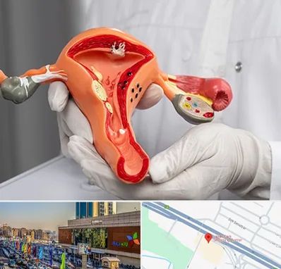 دکتر سرطان رحم در لاله پارک تبریز