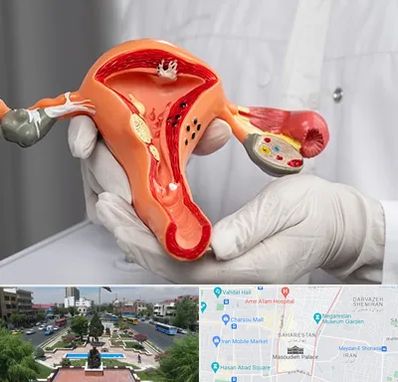 دکتر سرطان رحم در بهارستان 