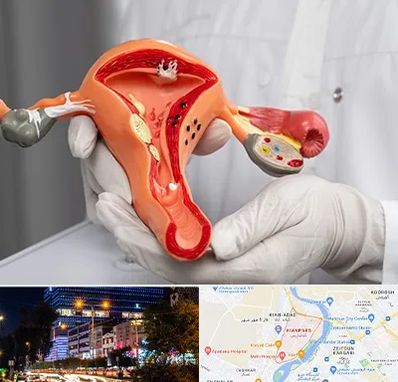 دکتر سرطان رحم در کیانپارس اهواز 