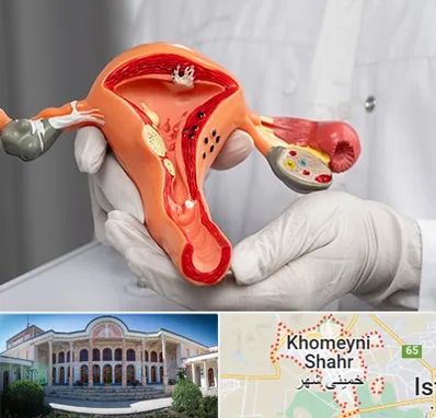 دکتر سرطان رحم در خمینی شهر