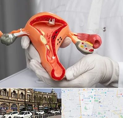 دکتر سرطان رحم در منطقه 11 تهران 