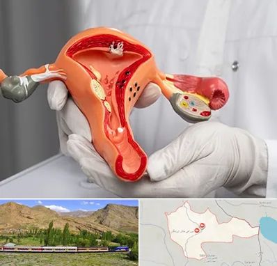 دکتر سرطان رحم در خاش