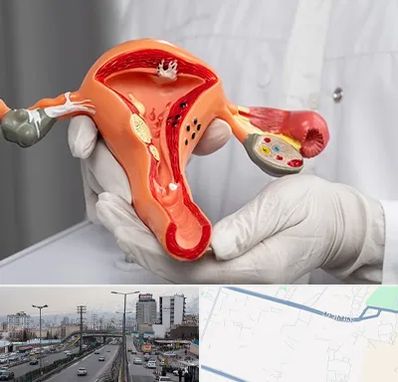 دکتر سرطان رحم در بلوار ارتش