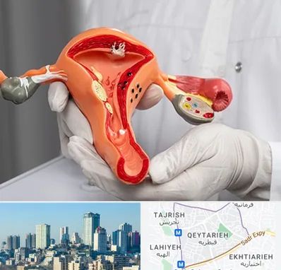 دکتر سرطان رحم در قیطریه 