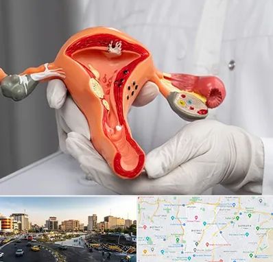 دکتر سرطان رحم در منطقه 7 تهران 