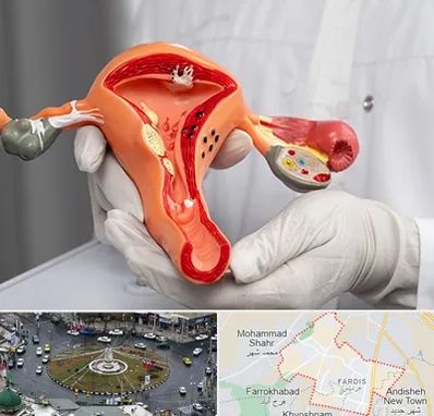 دکتر سرطان رحم در فردیس کرج 