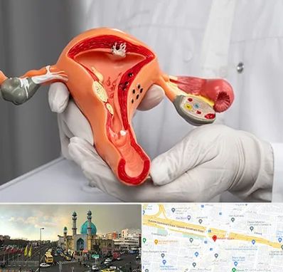 دکتر سرطان رحم در رسالت 