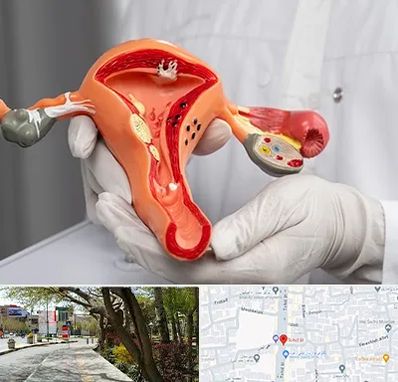 دکتر سرطان رحم در خیابان توحید اصفهان 