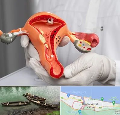 دکتر سرطان رحم در بندر انزلی