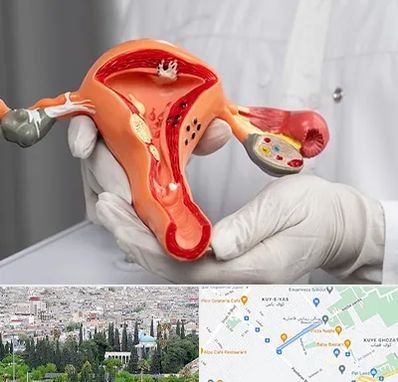 دکتر سرطان رحم در محلاتی شیراز 