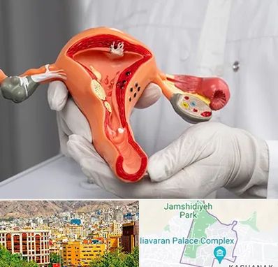 دکتر سرطان رحم در نیاوران 