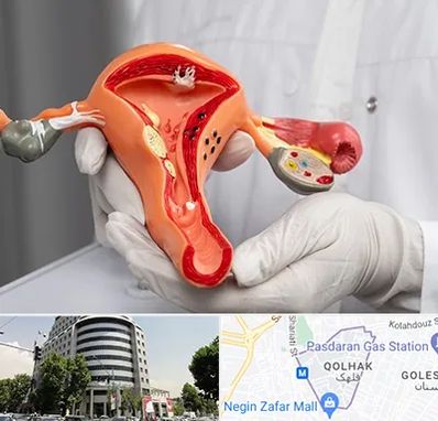 دکتر سرطان رحم در قلهک 