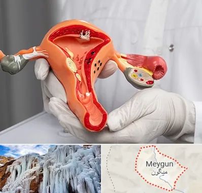 دکتر سرطان رحم در میگون