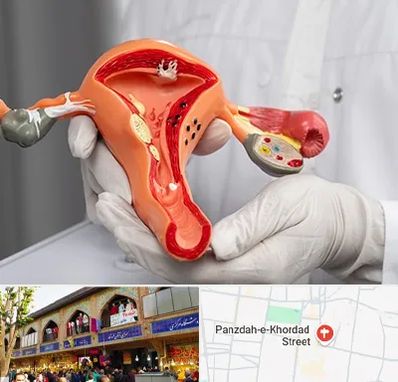 دکتر سرطان رحم در 15 خرداد