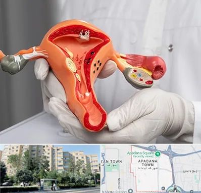 دکتر سرطان رحم در آپادانا