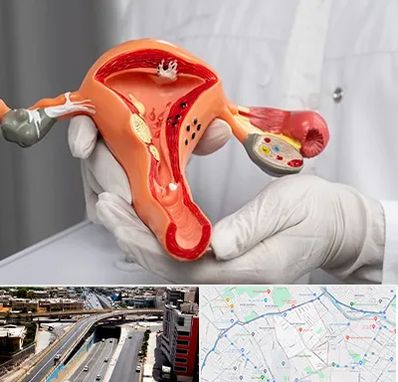 دکتر سرطان رحم در ستارخان شیراز 