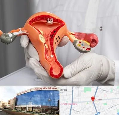 دکتر سرطان رحم در نصف راه تبریز