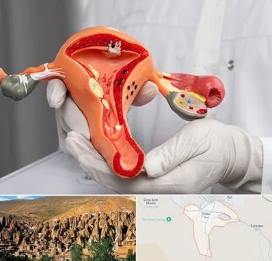 دکتر سرطان رحم در اسکو