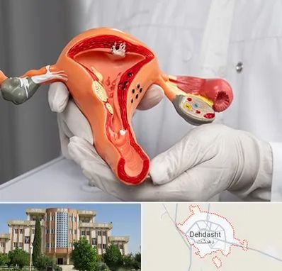 دکتر سرطان رحم در دهدشت