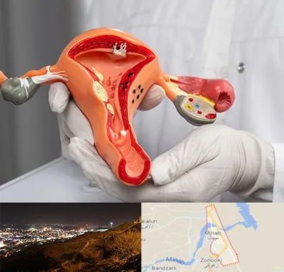دکتر سرطان رحم در میناب