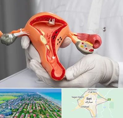 دکتر سرطان رحم در ساری