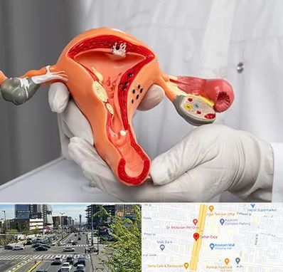 دکتر سرطان رحم در ستاری 