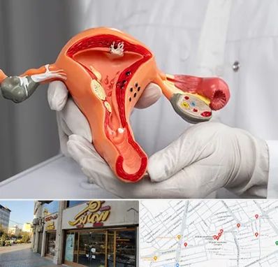 دکتر سرطان رحم در عطاران قم