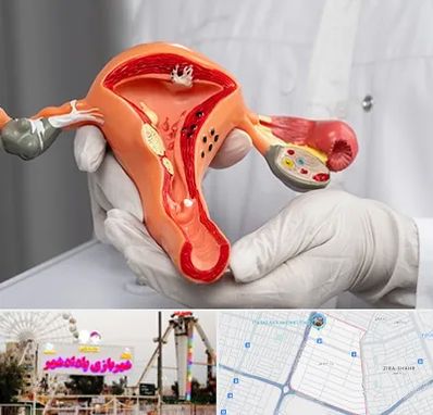 دکتر سرطان رحم در پادادشهر اهواز