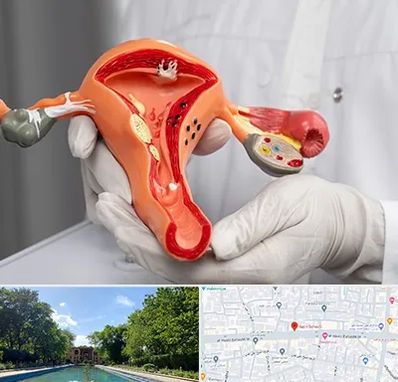 دکتر سرطان رحم در هشت بهشت اصفهان 