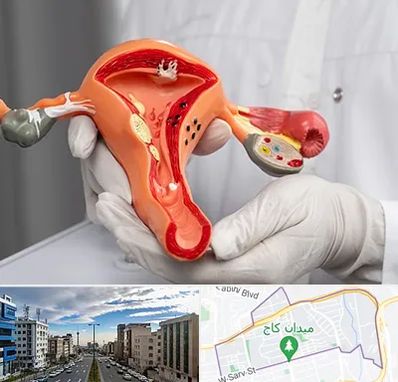 دکتر سرطان رحم در سعادت آباد 