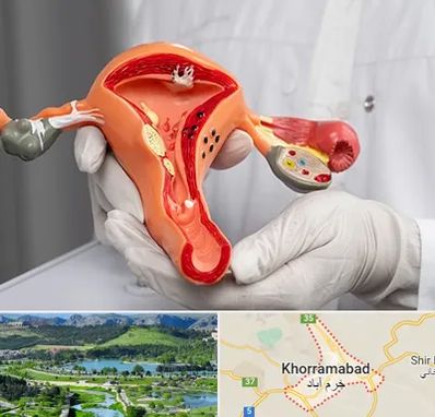دکتر سرطان رحم در خرم آباد