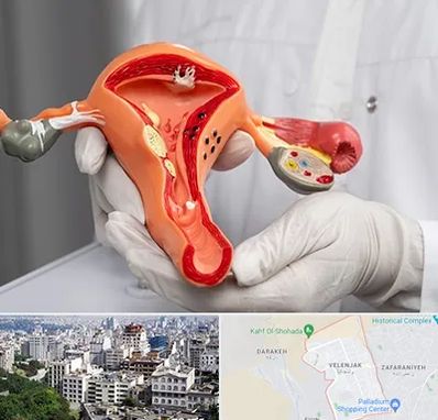 دکتر سرطان رحم در ولنجک 