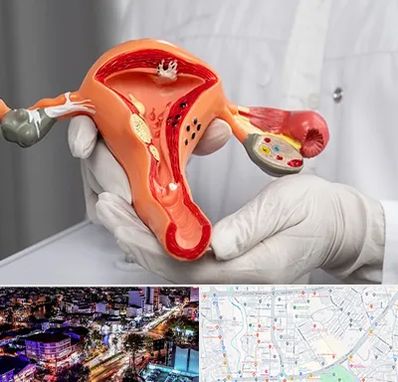 دکتر سرطان رحم در منظریه رشت 