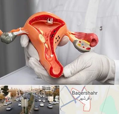دکتر سرطان رحم در باقرشهر